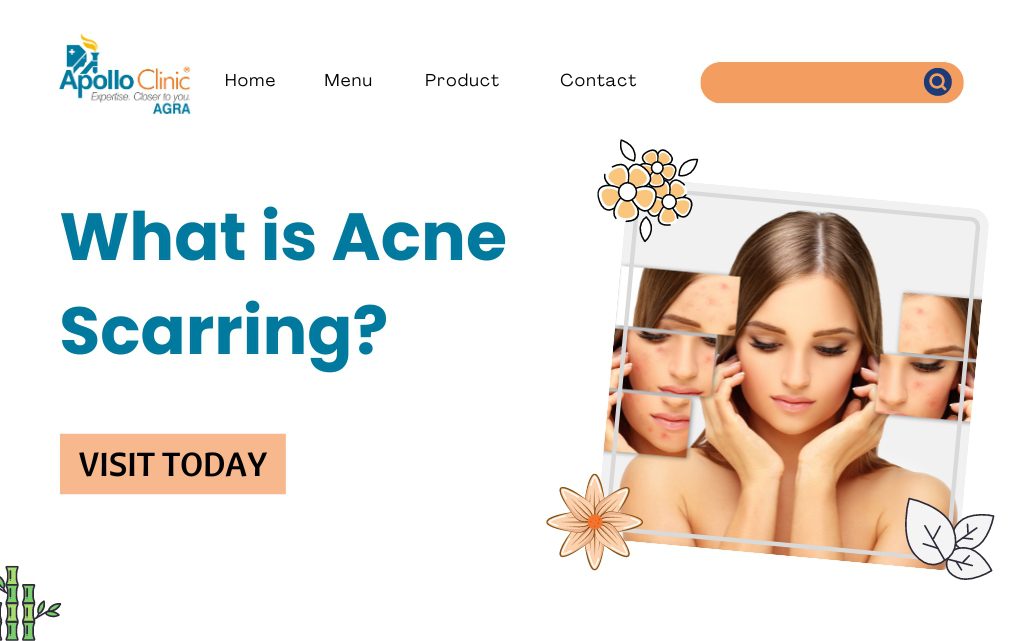 Acne Scarring